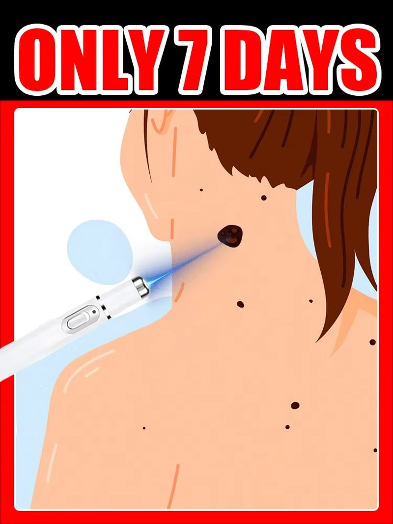 Wart Care Tools，Hot Selling Blue Light Pen to Solve Body Warts